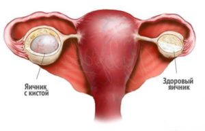 Кисты и кистомы яичников