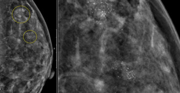 Округлые кальцинаты. Маммография микрокальцинаты. Гамартома молочной железы рентген. Маммография раковые микрокальцинаты. Кальцинаты на маммографии.