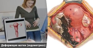 Эндометриоз матки и беременность