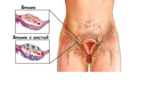 Как понять что застудила яичники