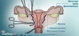 Удалили матку и трубы оставили яичники последствия