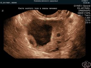Киста желтого тела левого яичника при беременности