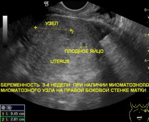 Миома или беременность как отличить на узи