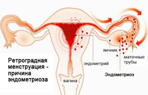 Менструация при эндометриозе