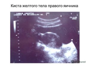 Киста желтого тела при беременности правого яичника