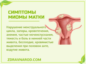 Какие симптомы при миоме матки