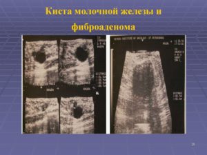 Киста молочной железы или фиброаденома