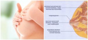 Болит молочная железа при лактации
