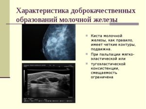Доброкачественные образования молочной железы