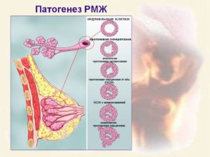 Патогенез рака молочной железы