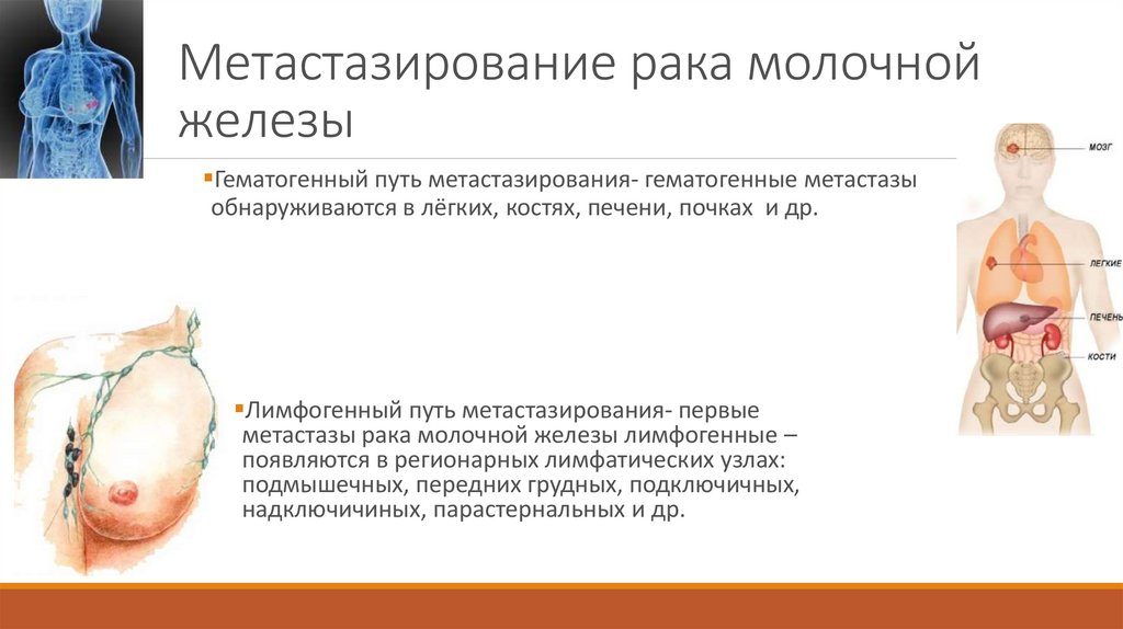 Метастазы в легких после рака молочной железы прогноз