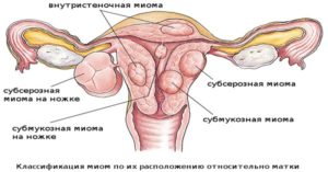 Чем миома отличается от кисты