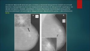 Фиброзно жировая инволюция молочных желез что это