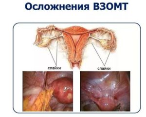 Спаечный процесс правого яичника