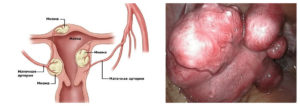 Миома матки от чего она появляется