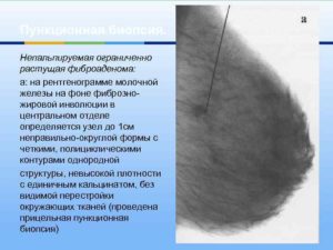 Что такое инволютивная фиброаденома молочной железы