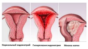 Гиперплазия эндометрия и миома матки это приговор
