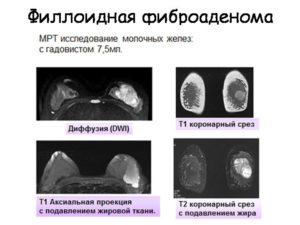 Филлоидная фиброаденома молочной железы