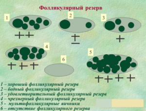 Снижение фолликулярного резерва яичников